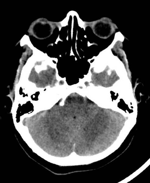 File:Cerebral edema due to severe hyponatremia (Radiopaedia 89826-106937 Axial non-contrast 20).jpg