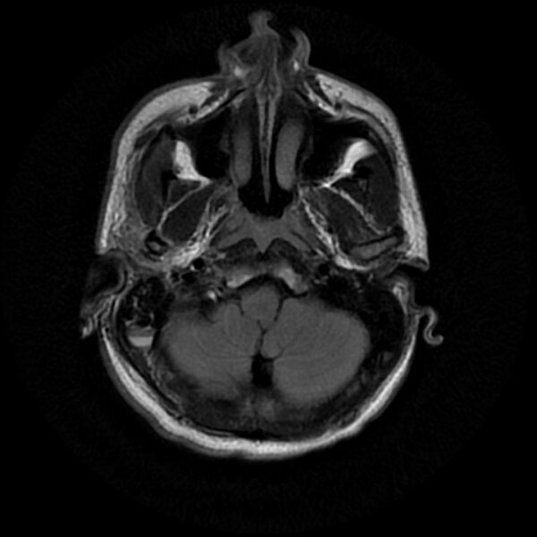 File:Cerebral fat embolism (Radiopaedia 37510-39363 Axial FLAIR 5).jpg