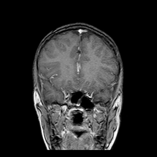 File:Cerebral tuberculoma (Radiopaedia 41152-43932 Coronal T1 C+ 5).jpg