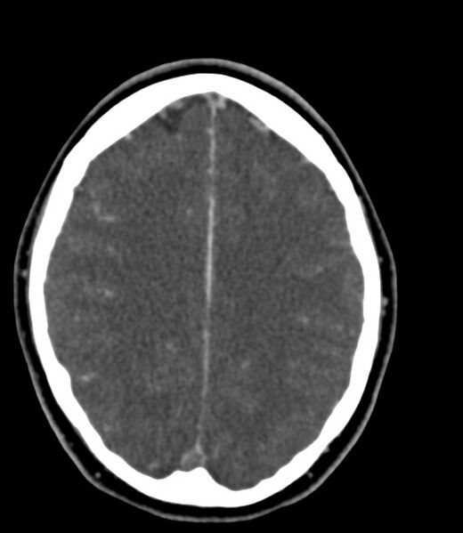 File:Cerebral venous sinus thrombosis (Radiopaedia 59224-66646 Axial C+ delayed 18).jpg