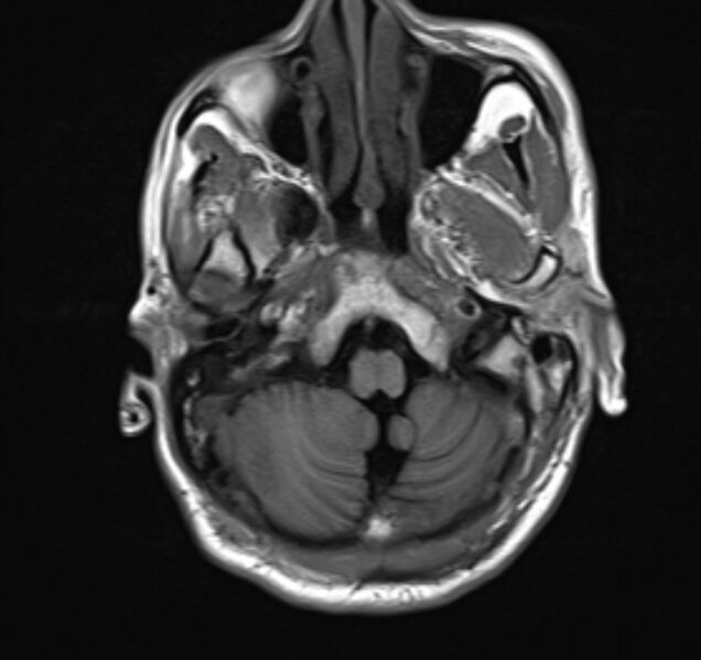 File:Cerebral venous thrombosis (Radiopaedia 71207-81504 Axial T1 5).jpg