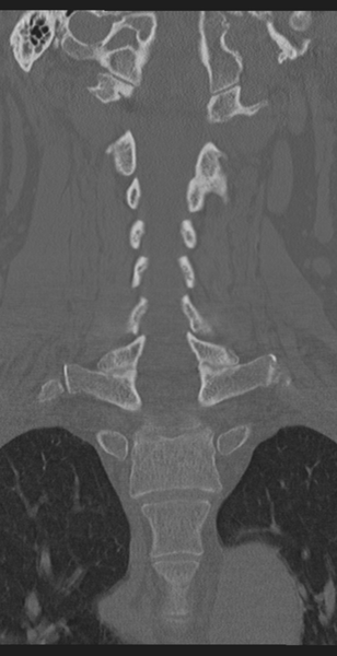 File:Cervical canal stenosis - OPLL and osteophytes (Radiopaedia 47329-51910 Coronal bone window 31).png