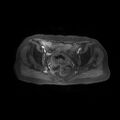 Cervical carcinoma (Radiopaedia 78847-91705 Axial T1 C+ fat sat 9).jpg