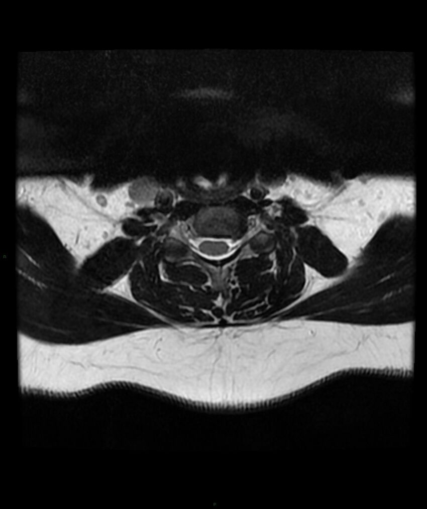 Cervical disc prolapse (Radiopaedia 80258-93598 Axial T2 38).jpg