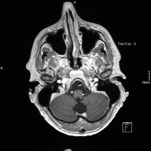 File:Cervical dural CSF leak on MRI and CT treated by blood patch (Radiopaedia 49748-54995 Axial T1 C+ 20).jpg