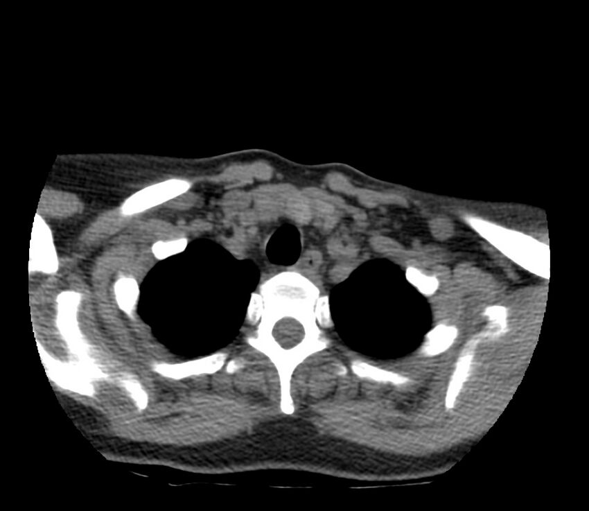 Cervical venous malformation (Radiopaedia 22653-22672 Axial non-contrast 50).jpg