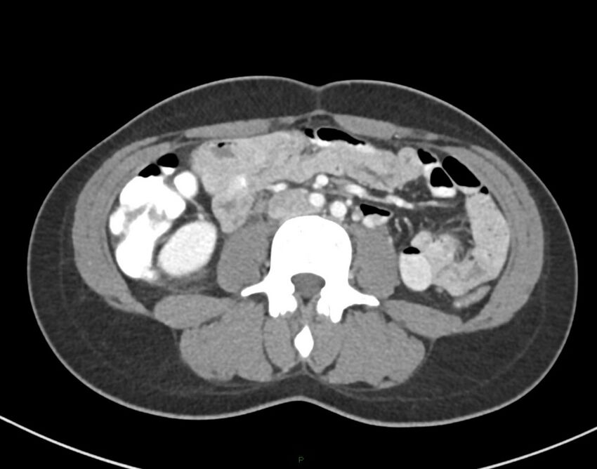 Cesarean scar endometriosis (Radiopaedia 82925-97262 A 45).jpg