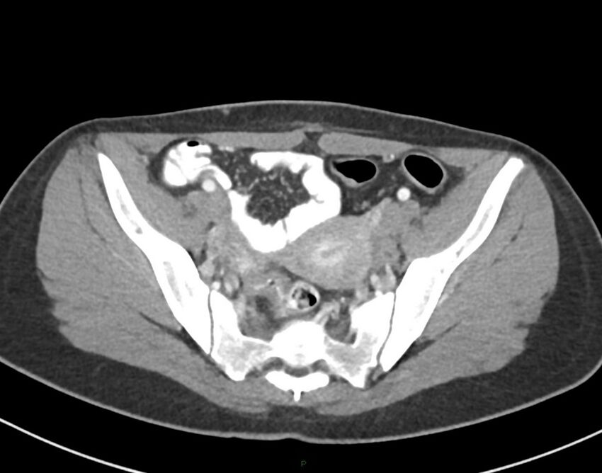 Cesarean scar endometriosis (Radiopaedia 82925-97262 A 69).jpg