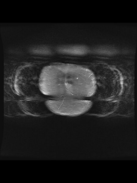 File:Cesarean section scar endometrioma (Radiopaedia 56569-63297 Coronal STIR 1).jpg