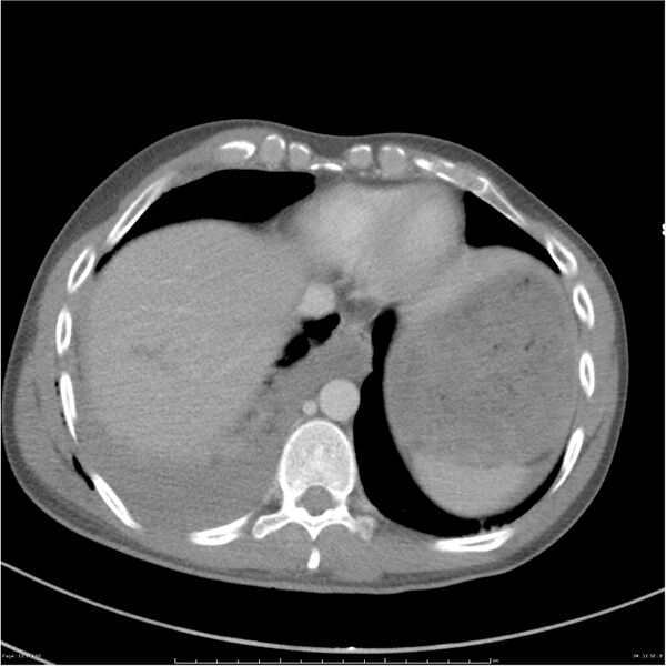 File:Chest and abdomen multi-trauma (Radiopaedia 26294-26426 bone window 12).jpg