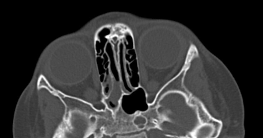 Choanal atresia (Radiopaedia 51295-56972 Axial bone window 43).jpg