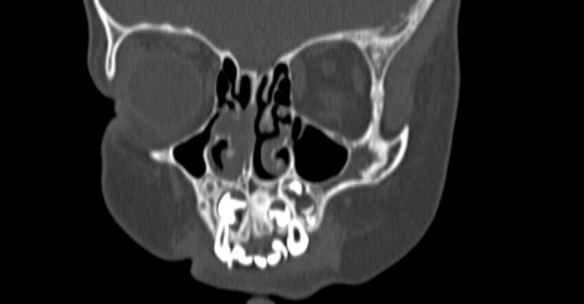 Choanal atresia (Radiopaedia 51295-56972 Coronal bone window 20).jpg
