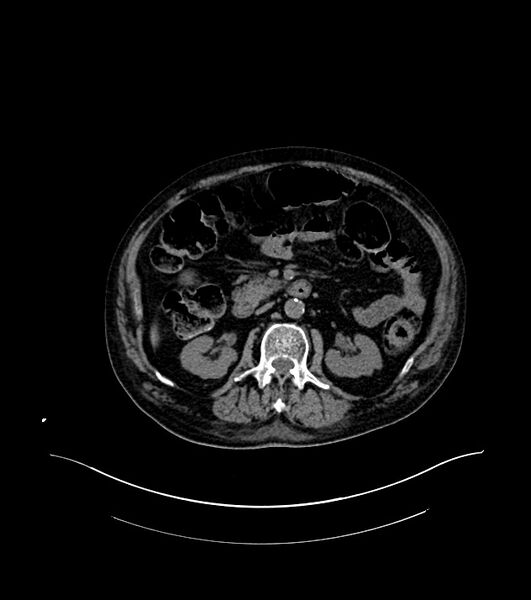 File:Cholangiocarcinoma with cerebral metastases (Radiopaedia 83519-98629 Axial non-contrast 45).jpg