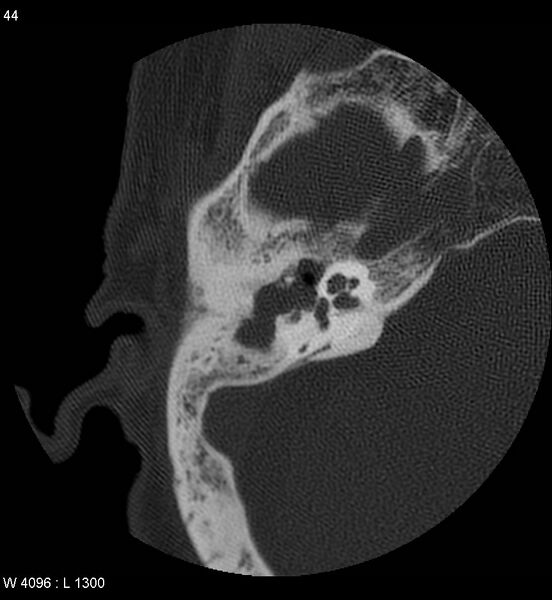 File:Cholesteatoma (Radiopaedia 5467-7197 Axial bone window 4).jpg