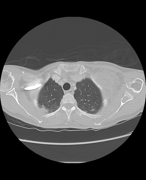 File:Chondrosarcoma (Radiopaedia 79427-92532 Axial lung window 9).jpg