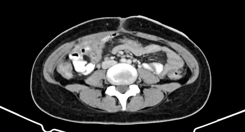 File:Choriocarcinoma liver metastases (Radiopaedia 74768-85766 A 127).jpg