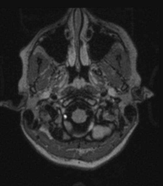 File:Choroid plexus carcinoma (Radiopaedia 91013-108553 Axial FLAIR C+ 77).jpg