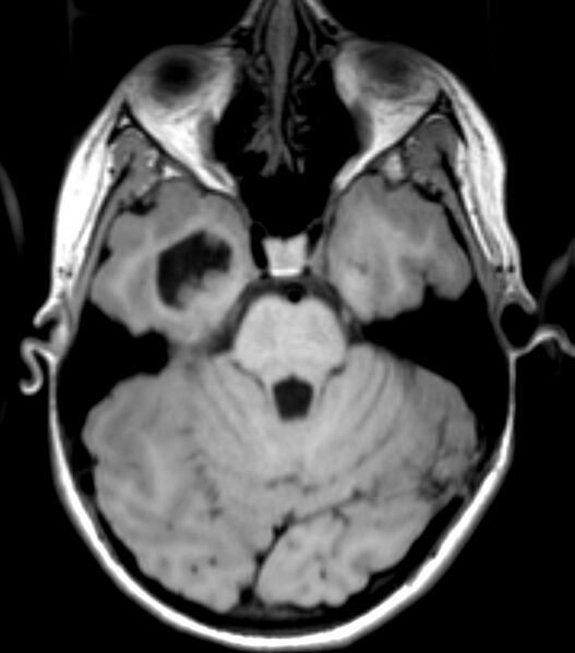 File:Choroid plexus carcinoma (Radiopaedia 91013-108553 Axial T1 61).jpg