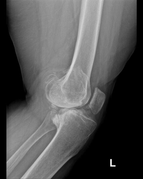File:Chronic knee dislocation (Radiopaedia 64998-73962 Lateral 1).jpg