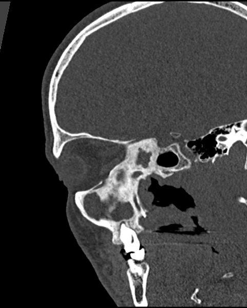 File:Chronic maxillary sinusitis caused by a foreign body (Radiopaedia 58521-65676 Sagittal bone window 41).jpg