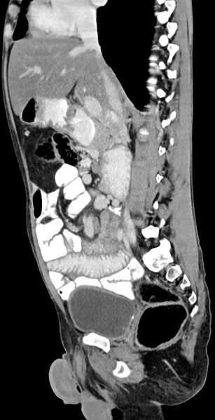 File:Chronic small bowel volvulus (Radiopaedia 75224-86322 C 85).jpg