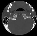 Clay-shoveler fracture (Radiopaedia 22568-22590 Axial bone window 3).jpg