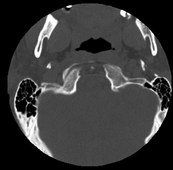 File:Clay-shoveler fracture (Radiopaedia 22568-22590 Axial bone window 3).jpg