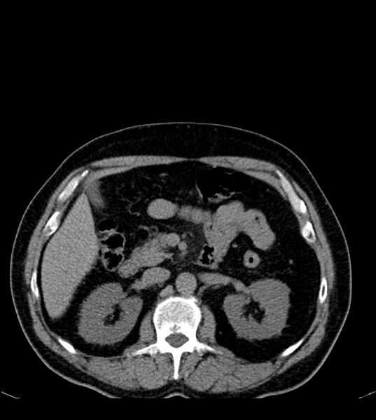 File:Clear cell renal cell carcinoma (Radiopaedia 85006-100539 Axial non-contrast 34).jpg
