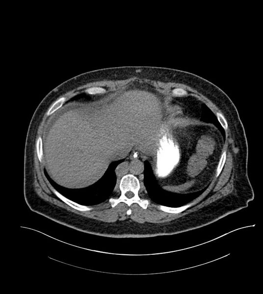 File:Closed-loop small bowel obstruction-internal hernia (Radiopaedia 78439-91096 Axial non-contrast 22).jpg