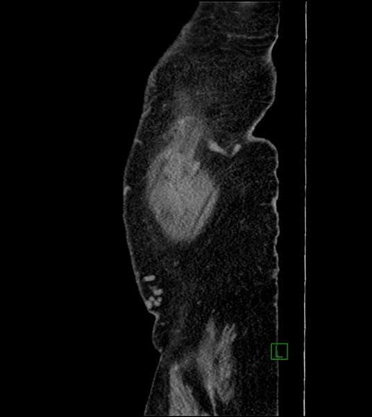 File:Closed-loop small bowel obstruction-internal hernia (Radiopaedia 78439-91096 C 136).jpg
