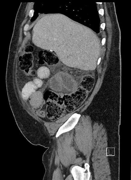File:Closed loop obstruction - internal hernia into nephrectomy bed (Radiopaedia 59867-67320 C 88).jpg