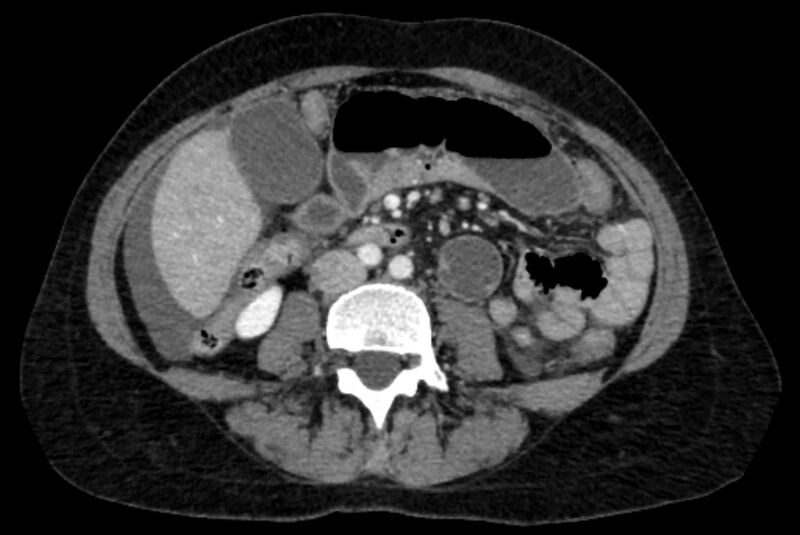 File:Closed loop small bowel obstruction (Radiopaedia 71211-81508 A 65).jpg
