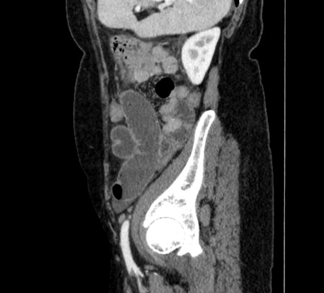 File:Closed loop small bowel obstruction (Radiopaedia 71211-81508 C 135).jpg