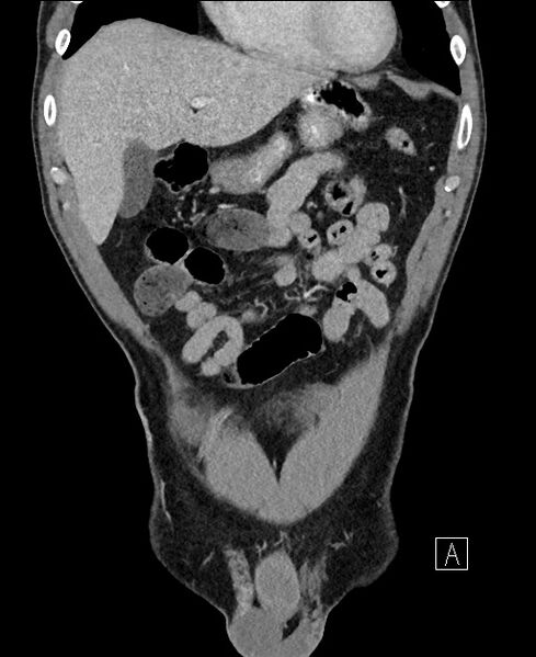 File:Closed loop small bowel obstruction - internal hernia (Radiopaedia 57806-64778 A 29).jpg