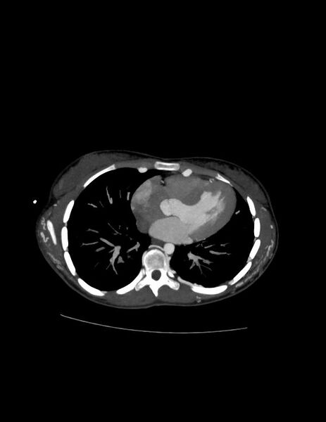 File:Coarctation of the aorta (Radiopaedia 27458-27657 D 16).jpg