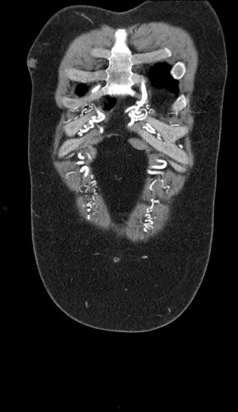 File:Coarctation of the aorta (Radiopaedia 74632-88521 B 1).jpg