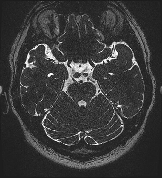 File:Cochlear incomplete partition type III associated with hypothalamic hamartoma (Radiopaedia 88756-105498 Axial T2 124).jpg