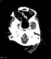 Colloid cyst (Radiopaedia 10638-11100 Axial non-contrast 1).jpg