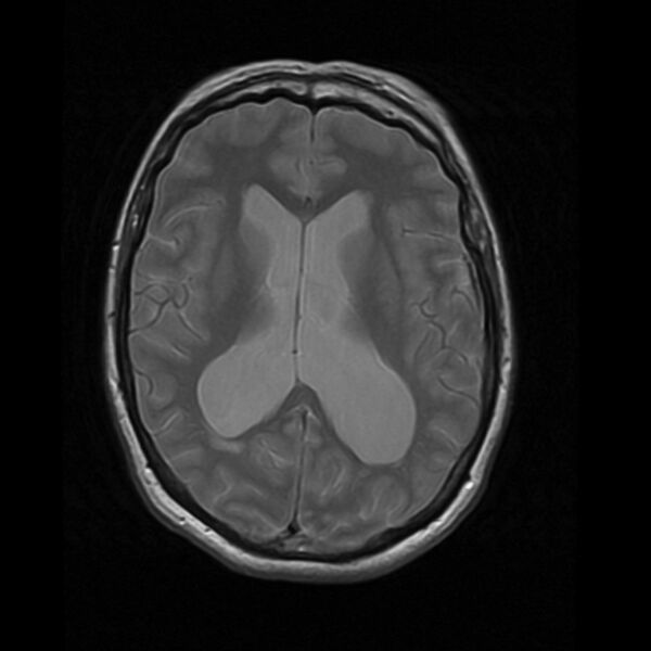 File:Colloid cyst with hydrocephalus (Radiopaedia 9373-10065 Axial PD 11).jpg