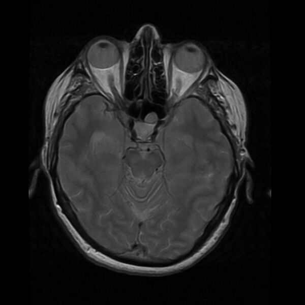 File:Colloid cyst with hydrocephalus (Radiopaedia 9373-10065 Axial PD 7).jpg