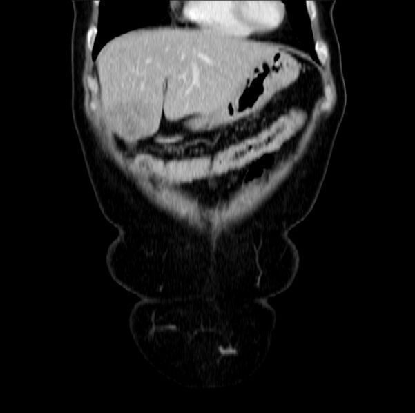 File:Colon carcinoma with hepatic metastases (Radiopaedia 29477-29961 B 10).jpg