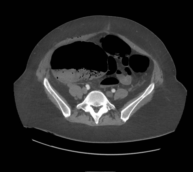 File:Colonic pseudo-obstruction (Radiopaedia 79752-92980 A 131).png