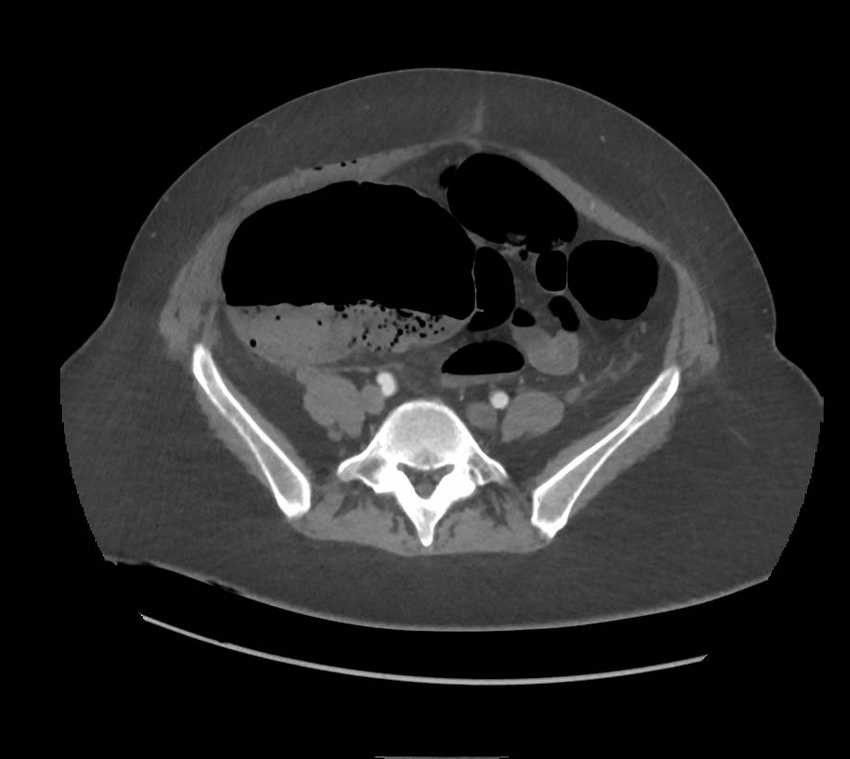 Colonic pseudo-obstruction (Radiopaedia 79752-92980 A 131).png