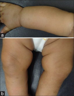 Swollen joints (age 2-months)