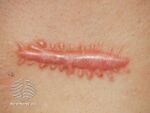 Hypertrophic scar (DermNet NZ procedures-surgical-scar03).jpg
