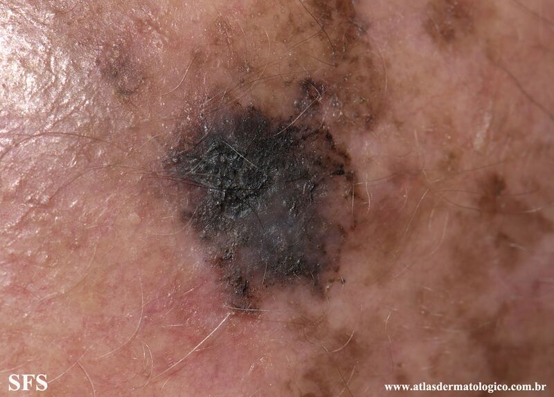 File:Melanoma (Dermatology Atlas 93).jpg