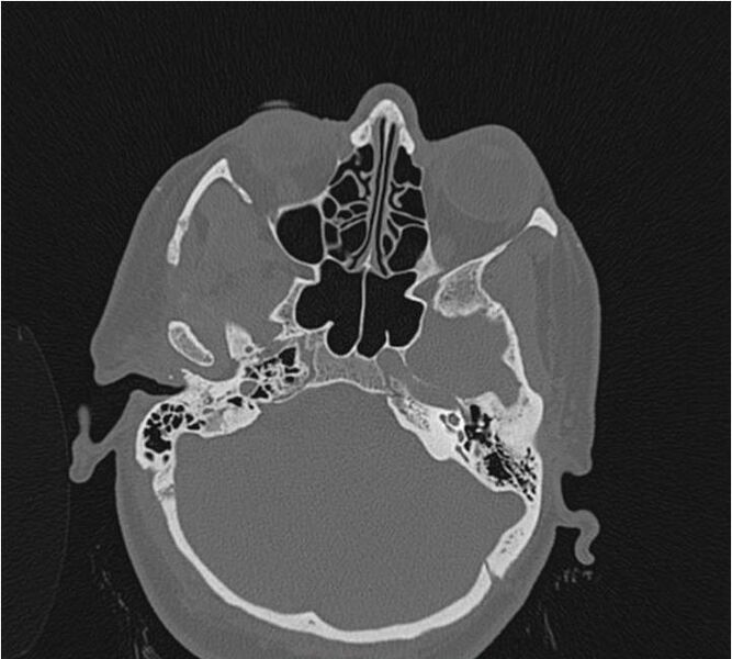 File:Nasolabial cyst (Radiopaedia 25322-25580 Axial bone window 19).jpg