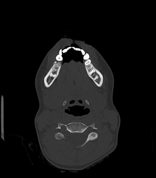 File:Nasoorbitoethmoid fracture (Radiopaedia 90044-107205 Axial bone window 28).jpg
