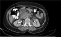 Necrotizing pancreatitis (Radiopaedia 20595-20495 Axial C+ delayed 18).jpg