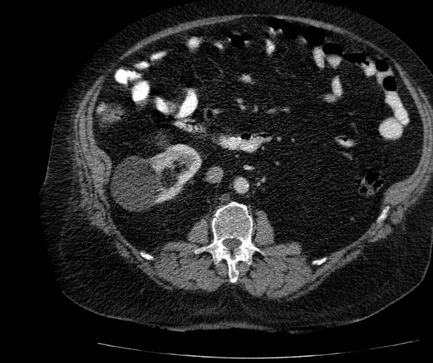 Nephroptosis with inguinal hernia containing perirenal fat (Radiopaedia 56632-63391 C 161).jpg